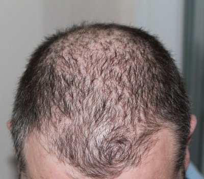 Male pattern baldness hair loss